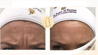 Choice of Botox Injections Options @ Dr Kamil Al Rustom Skin and Laser Centre Dubai from AED 99